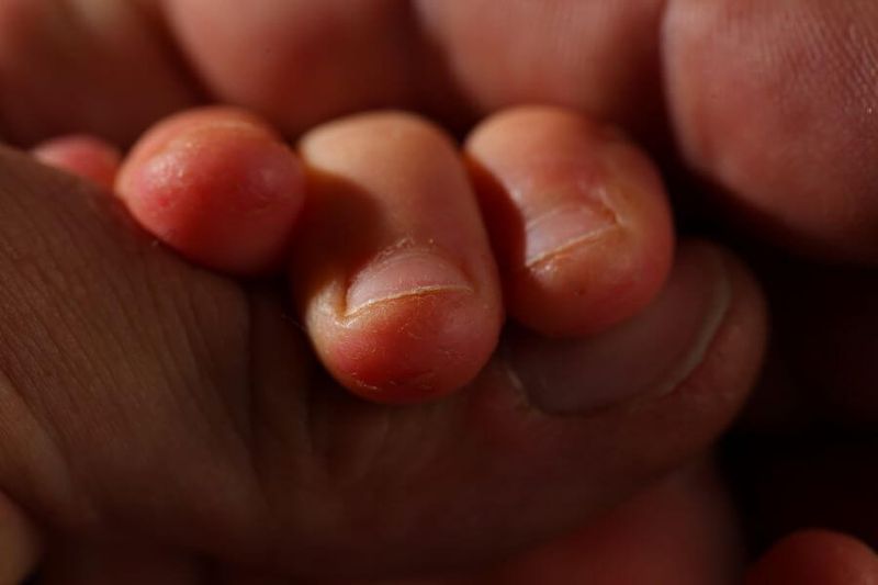 9 Common Nail Disorders in Children article image