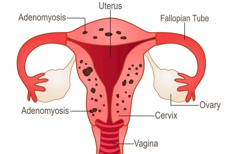 What is Adenomyosis? article image