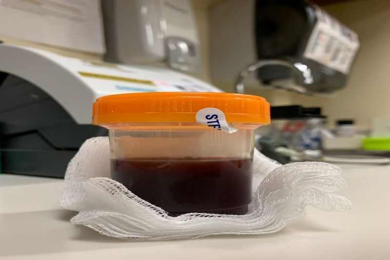 Blood in Your Child’s Urine? it Could be Hematuria article image