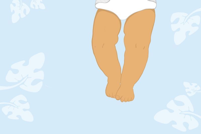 Bowlegs in Infants and Toddlers article image