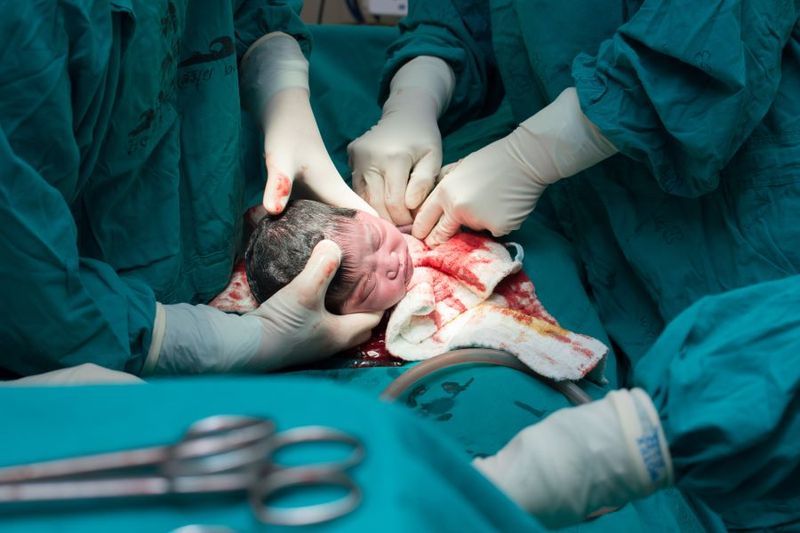 C-section Rates now 33 Percent of all Births article image