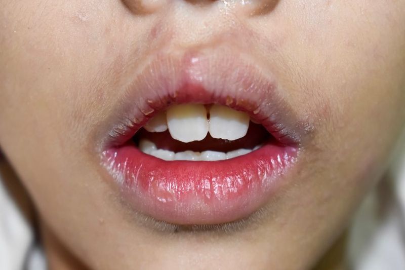 Extremely Chapped Lips? Your Child may Have lip Licker’s Dermatitis article image