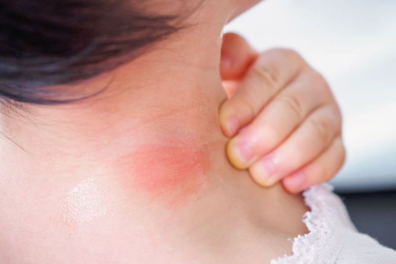 How do we know if a bug Bite is Infected? article image