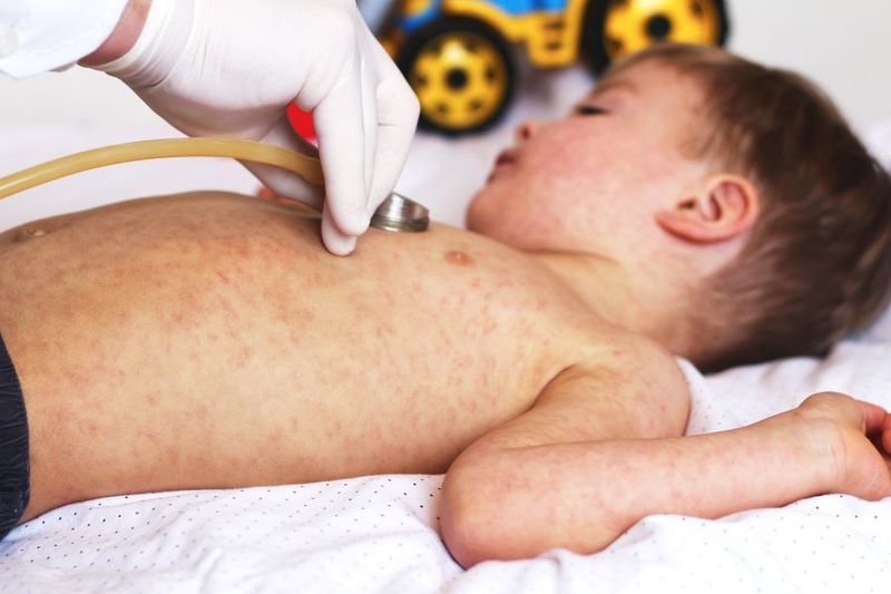 Measles in 2018: Should you Worry? article image