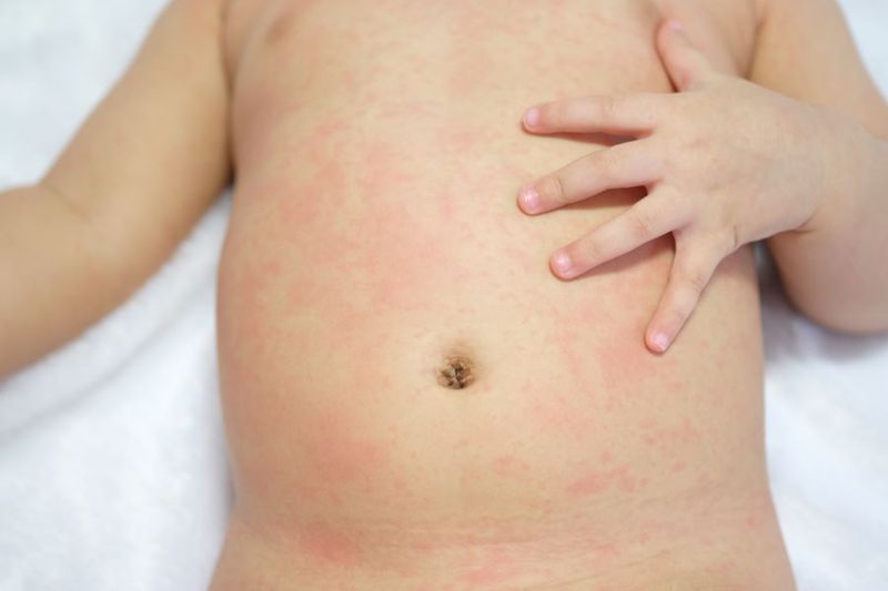 My Toddler has an Itchy, red, Scaly Rash Around the Belly Button. What Could it Be? article image