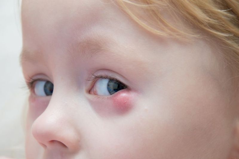 Nasolacrimal Duct Obstruction in Babies article image