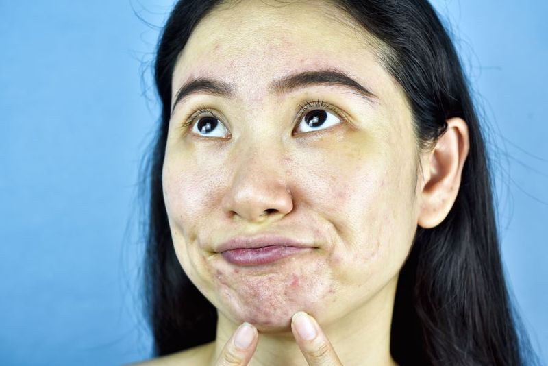 Pregnancy After Cystic Acne Medications: is it Safe? article image