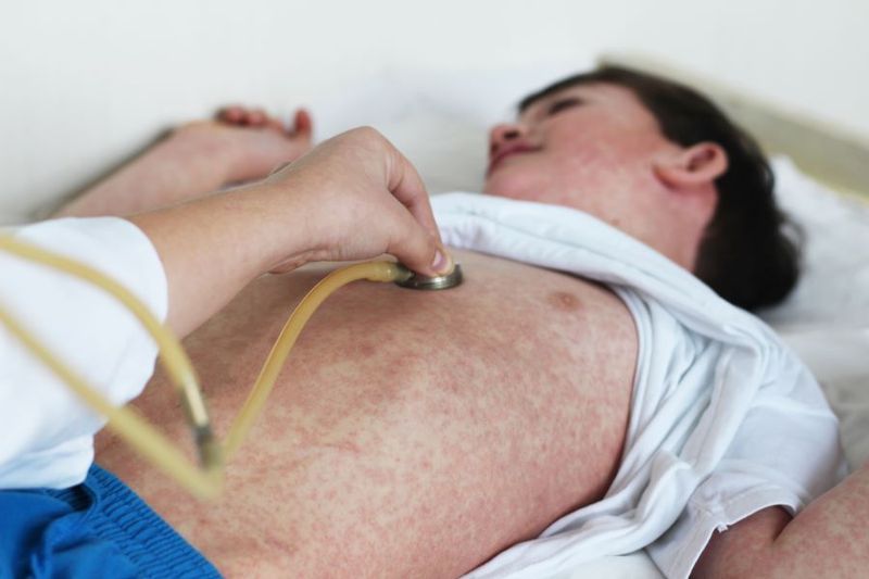 What Does Measles Look Like? article image
