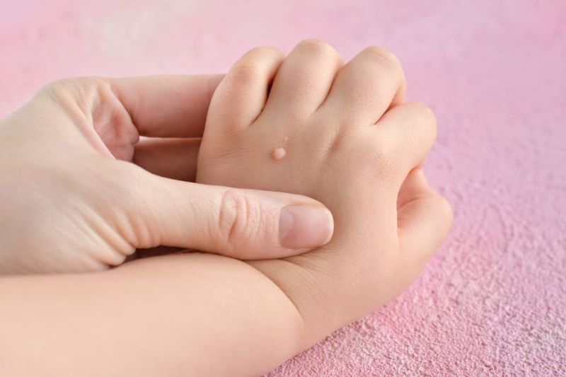 What Should I do if my Child has a Wart? article image