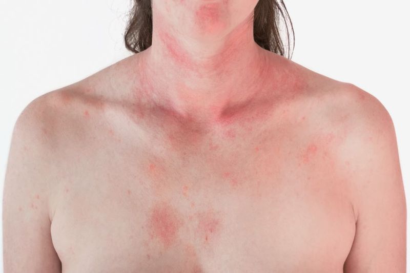 What is Cold Panniculitis? article image