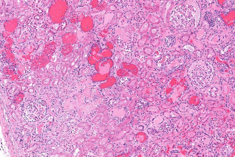 What is Hemolytic Uremic Syndrome? article image