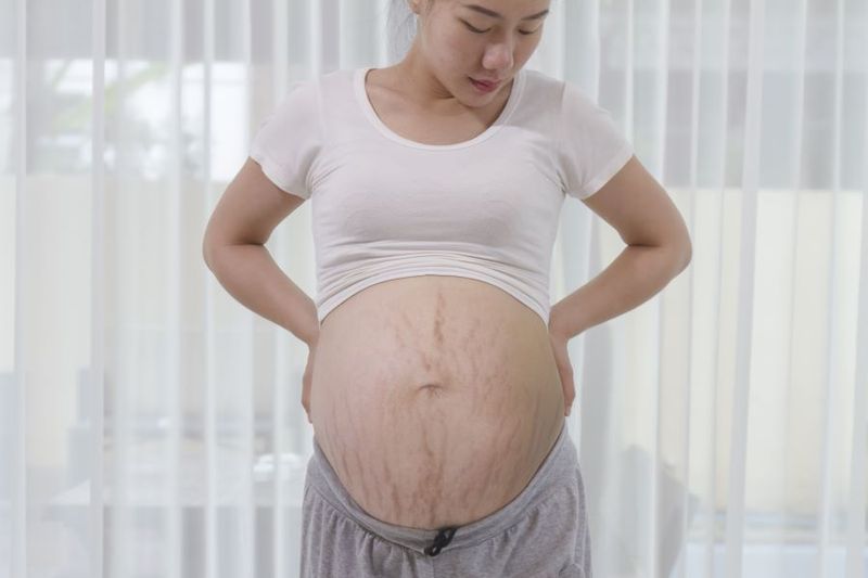 Why do my Stretch Marks Itch? article image